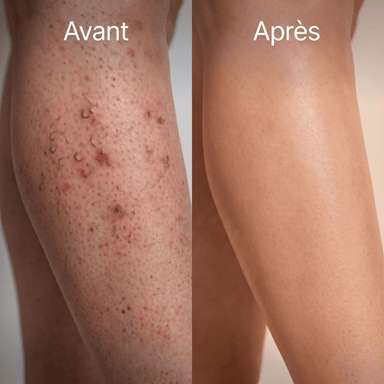 DermaSkin - Rouleau anti poils incarnés